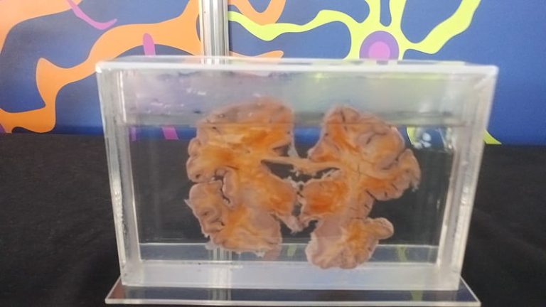 Farmacêutica inicia testes da vacina contra o Alzheimer em humanos