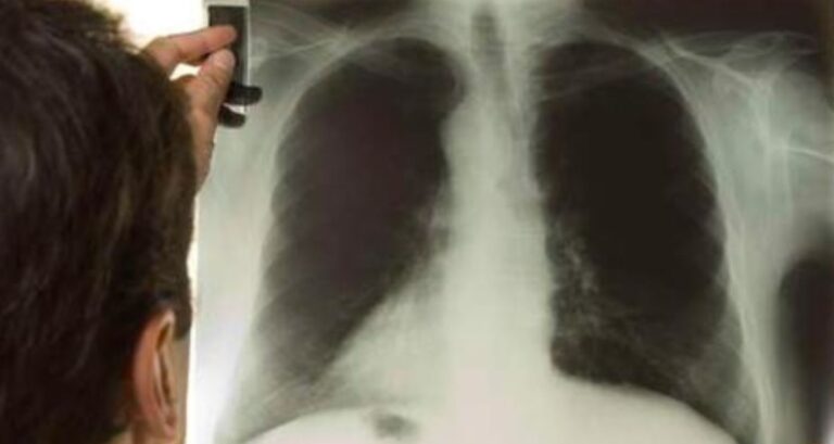 Sabia que a Abreugrafia é um invento brasileiro e transformou a história da medicina mundial?