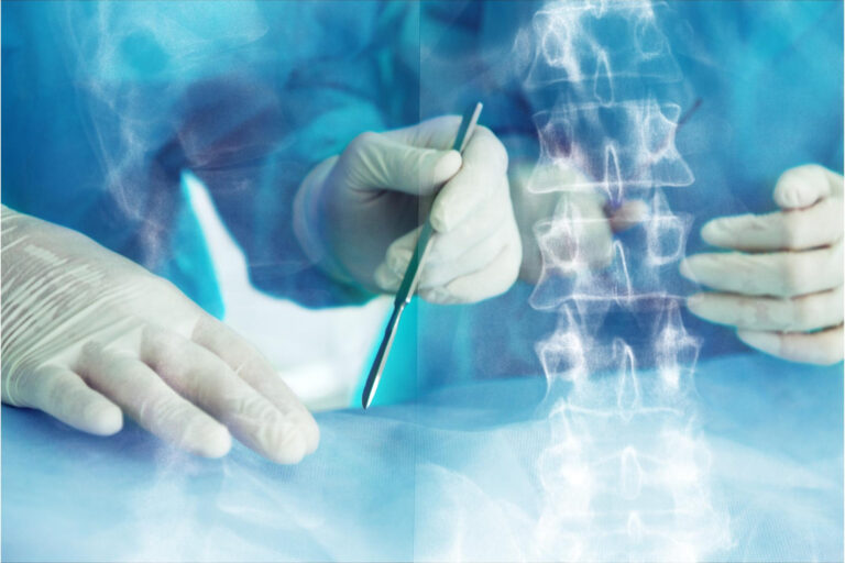 Dor na coluna: quando a cirurgia é realmente necessária?