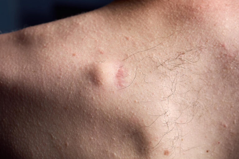 Lipoma: quando um caroço sob a pele deve ser investigado?