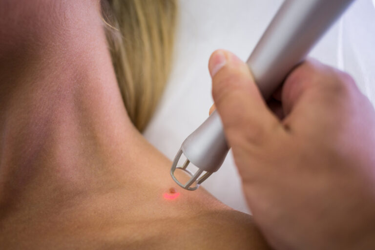 Laser de Alta Intensidade acelera recuperação e reduz dor sem uso de medicamentos