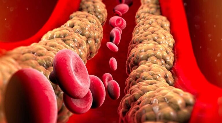 Colesterol alto: FDA aprova primeiro inibidor oral da PCSK9